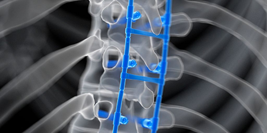 Federal investigation into spine surgeries uses mob laws to target healthcare fraud - Vimarsana News