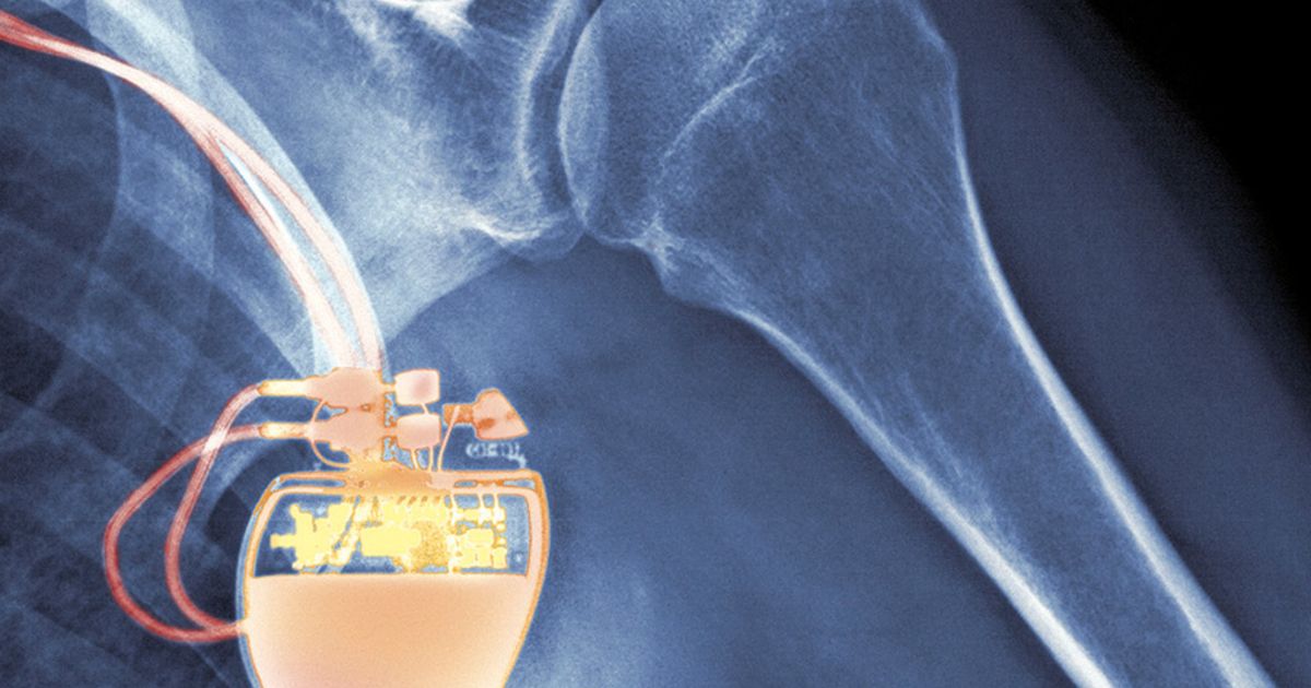 Boston Scientific gets subpoena about defibrillator performance